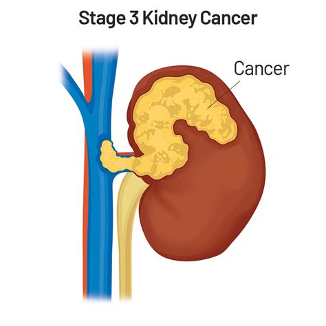 Ureteral Cancer and Ureteral Urothelial Carcinoma | Saint John’s Cancer ...