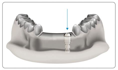 Digital Laboratory Analogues Southern Implants