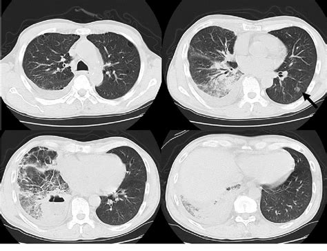 Figure 1 From A Case Of Primary Lung Cancer With A Thin Walled Cavitary Growth Process Under