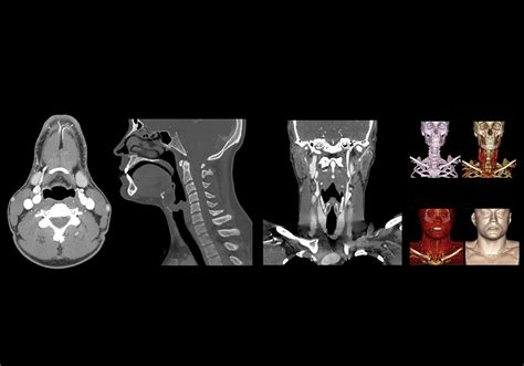 Normal Neck Ct Scan