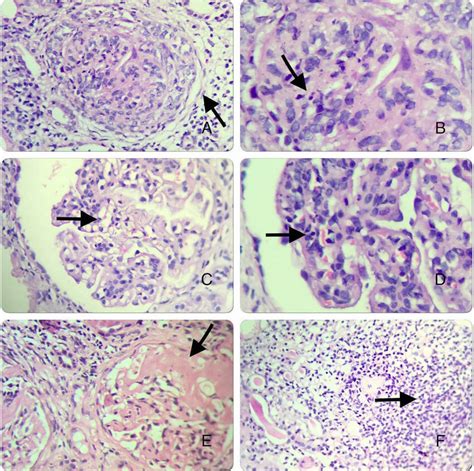 A Cellular Crescents B Fibrinoid Necrosis C Endocapillary