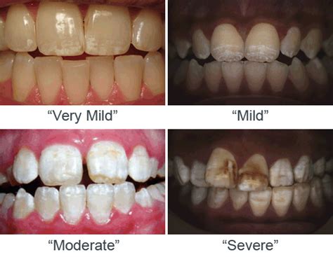 Dental Fluorosis - Fluoride Action Network