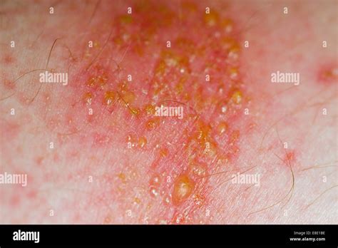 Staphylococcus Aureus Impetigo