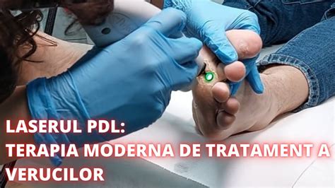 Eliminarea Verucilor Cu Laser Vascular PDL DermaBeauty Clinique YouTube