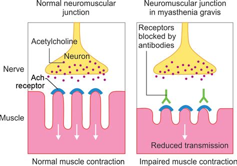 Thymus Gland Function And Myasthenia Gravis At Noah Janet Blog