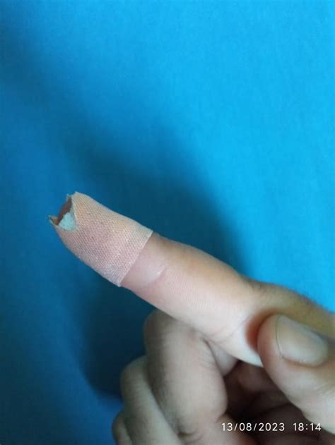 DIY accident: Laceration on my finger : r/Injury