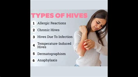 Effective Homeopathy Treatment For Hives Youtube