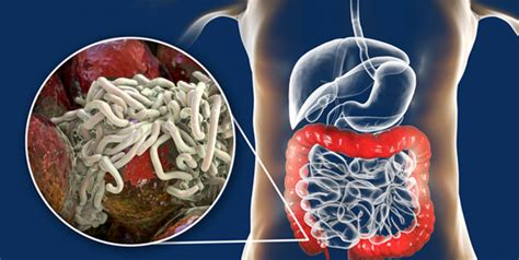 Whipworm Infection All You Need To Know About This Parasitic Infection