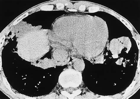 Imaging Of Occupational Lung Disease Radiographics