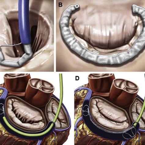 1 Percutaneous Mitral Valve Anchoring Systems A Atrial Flange And