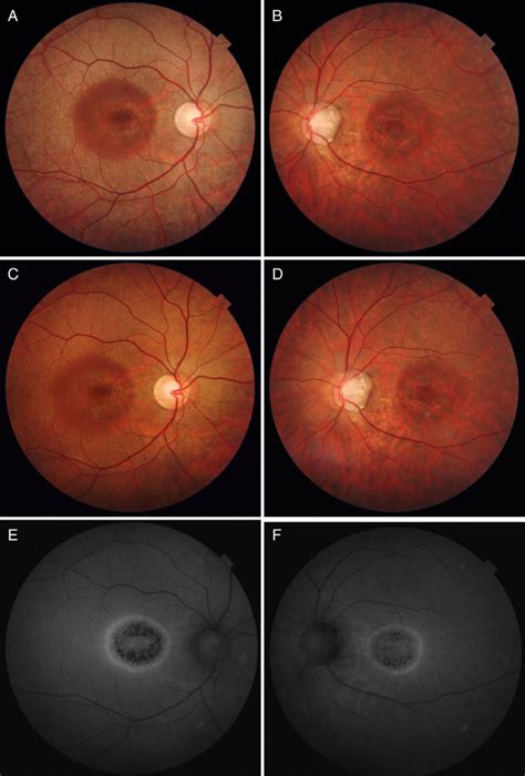 Colour Fundus Photograph Of The Right A And The Left B Eyes Showing