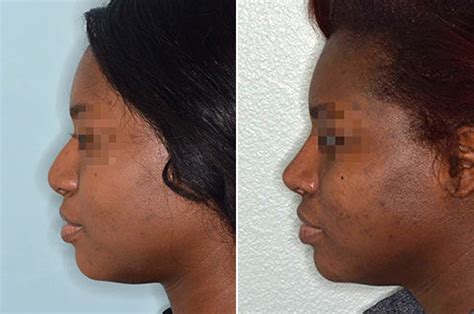 Nose Job Before And After Profile