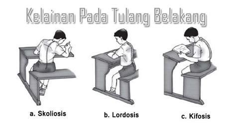 Nama Nama Penyakit Tulang Belakang Isaac Jackson