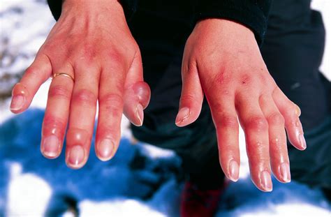 Frostbite Definition Symptoms Stages And Facts Britannica