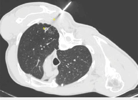 Transthoracic Needle Biopsy Axial Ct Scan Image Showing Posterior Download Scientific Diagram