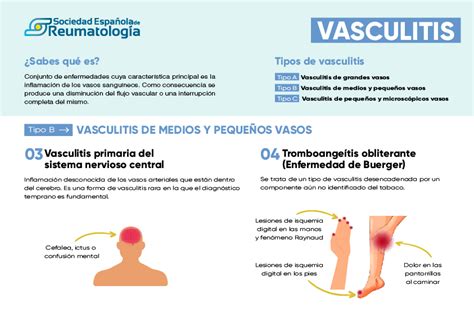 Tipos De Vasculitis Inforeuma