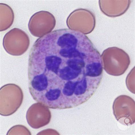 Hypersegmented neutrophil