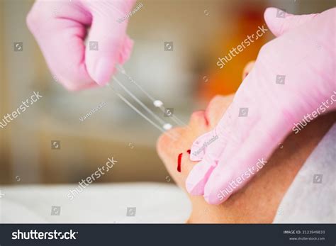 Thread Lifting Minimally Invasive Procedure Tightening Foto Stock