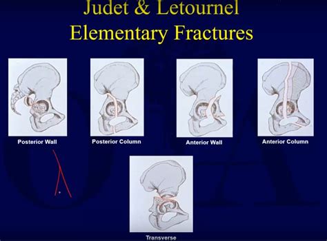 Acetabular Fracture Classification —