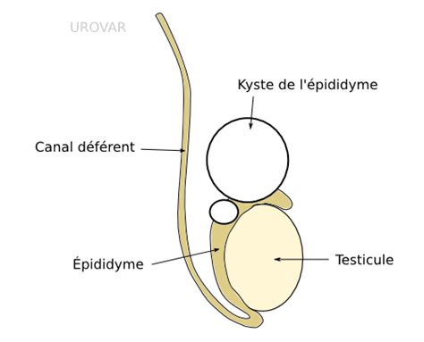 Kyste De L Pididyme Kyste Testiculaire Causes Et Traitement Naturel