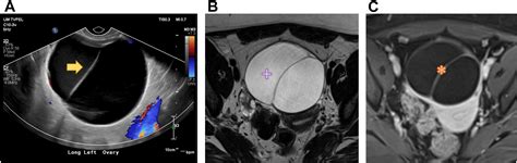 Adnexal Mass Imaging Contemporary Guidelines For Clinical Practice Radiologic Clinics