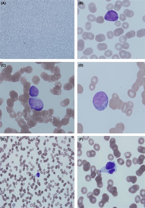 Peripheral blood smear showing: (A) marked pancytopenia. (B and C) Rare... | Download Scientific ...