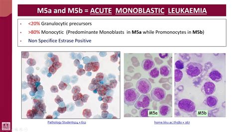 Hematology 2 U2 L28 Fab Classification Of Aml Subtypes 7 Youtube