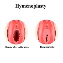 Types Of Hymen Imperforate Annular Denticular Cribriform Dentate