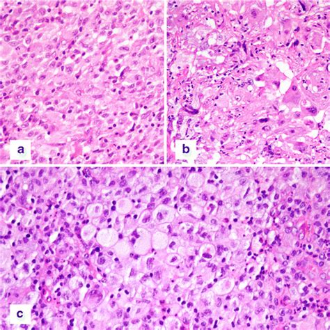 Histiocytic Sarcoma Cytology May Be Monomorphic As In Case 149 A By