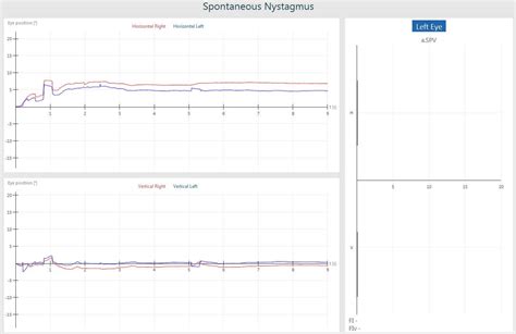 VisualEyes™ | Spontaneous Nystagmus | Interacoustics