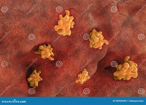 Entamoeba Histolytica Invading Intestine Coloso