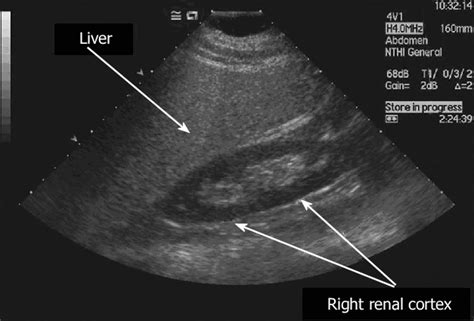 Nonalcoholic Fatty liver Disease Bedside Ultrasound Diagnosis - SIFSOF