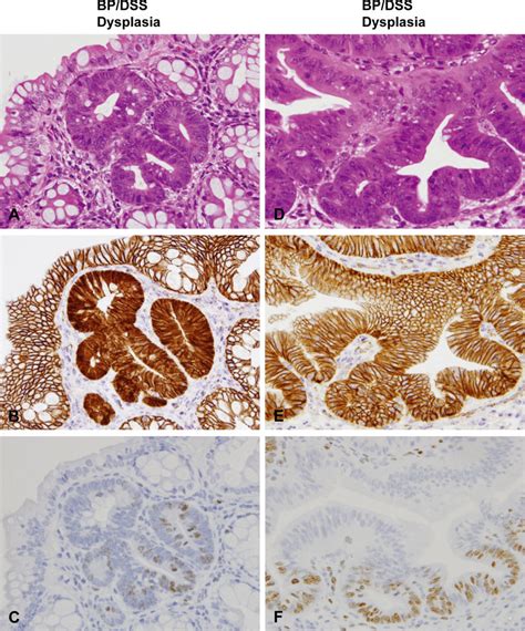 Histopathology With H And E Stain A And D And Immunohistochemistry Of