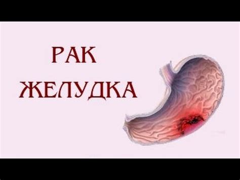 Современные способы лечения рака желудка на разных стадиях - YouTube