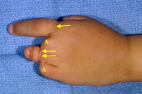 Constriction Bands Amniotic Hand Surgery Resource