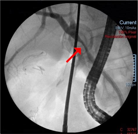 Intraoperative Ercp Showing Stenosis Of Cbd Red Arrow Showing Stenosis Download Scientific