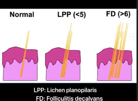 Challenge Case Of Compound Follicles Final Diagnosis Lichen