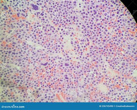 Plasmablastic Anaplastic Multiple Myeloma Close Up Of Plasma Cells