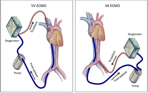 Extracorporeal Membrane Oxygenation During Adult Noncardiac Surgery And