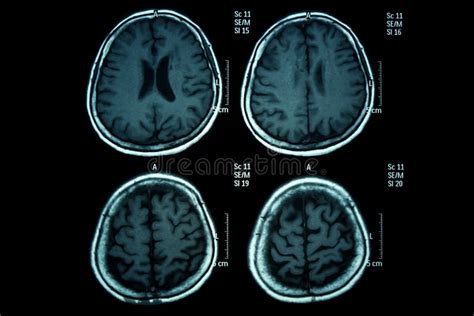 Tumor Cerebral Imagem De Stock Imagem De C Ncer Parietal