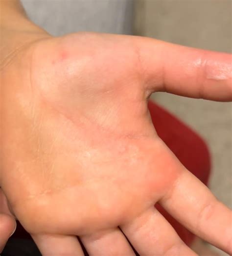 Nurse Mom Stumped What Kind Of Rash On My 5 Yr Old’s Palm And Sole R Dermatologyquestions