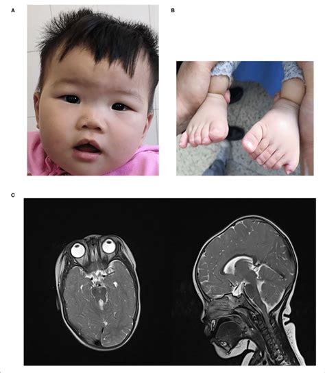 A Craniofacial Dysmorphism B Polydactyly C Mts In Brain Mri