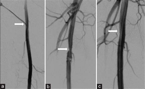 Safety And Efficacy Of Angio Seal Closure In Antegrade Superficial