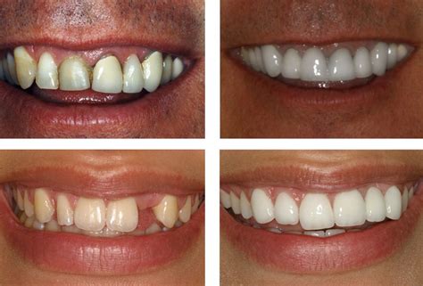 21 Dental Implant Before and After Photos