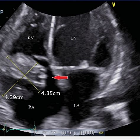 Transthoracic Echocardiogram Via Four Chamber View With A Red Arrow Download Scientific Diagram