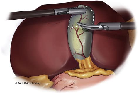 A Step By Step Guide To Laparoscopic Subtotal Fenestrating