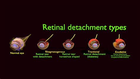 Retinal Detachment Types Eye 3d Model Buy Royalty Free 3d Model By