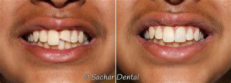 Dental Crowns Before And After