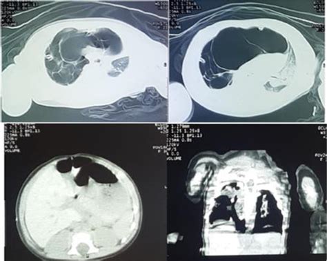 Figure 2 From Congenital Cystic Adenomatoid Malformation A Rare Serial Case Report Semantic