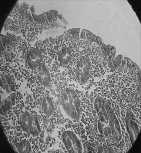 Duodenal Mucosa Revealed Marked Villous Atrophy And Intraepithelial